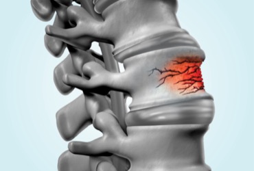 Kyphoplasty for Osteoporotic Vertebral Compression Fracture